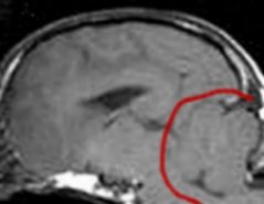 MRI crushed cerebellum 2 comp