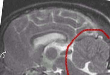 MRI full cerebellum for comp