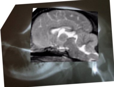 side head xray with MRI cmalf mild no sm