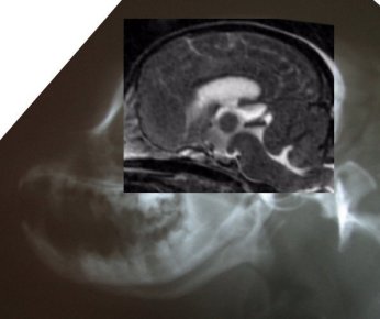 Side head xray with MRI smalsev sm