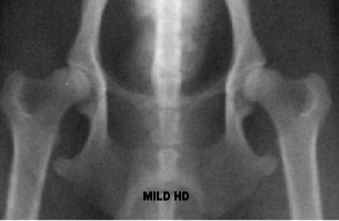 mild hip dysplasia