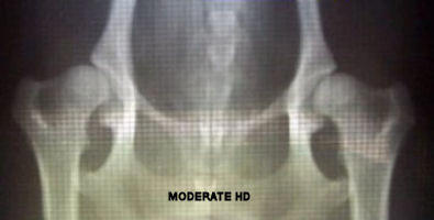 moderate hip dysplasia